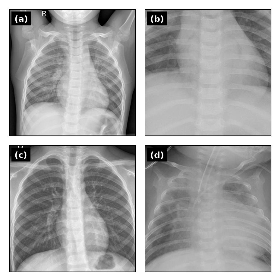 Göğüs röntgeni görüntülerinden zatürre tanısında derin öğrenme tabanlı yaklaşımların performans analizi — Figure 3